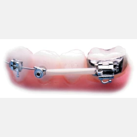Orhodontic Archwire Sleeve
