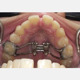 MARPE palatal expander with key